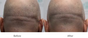 Scalp Micropigmentation for Scar Camouflage