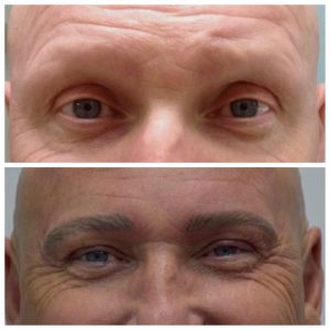 brow hair loss restoration Atlanta GA