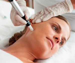 microneedling sun spots