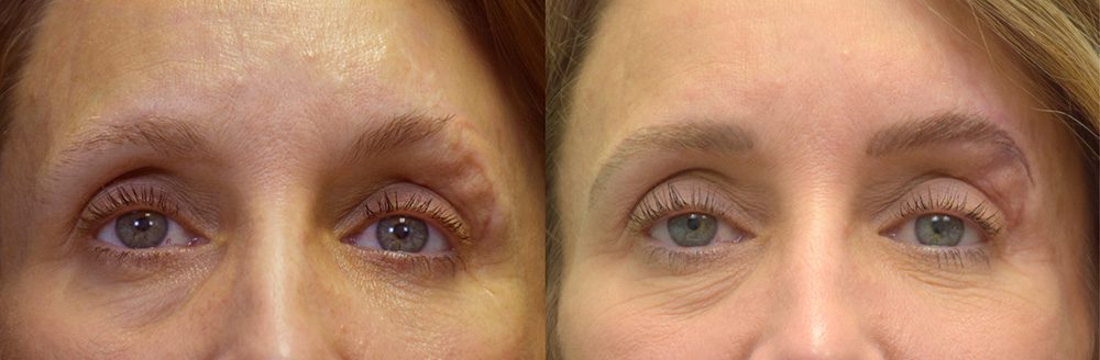 Restore Missing Brows With Scars