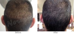 Scalp Micropigmentation Atlanta GA