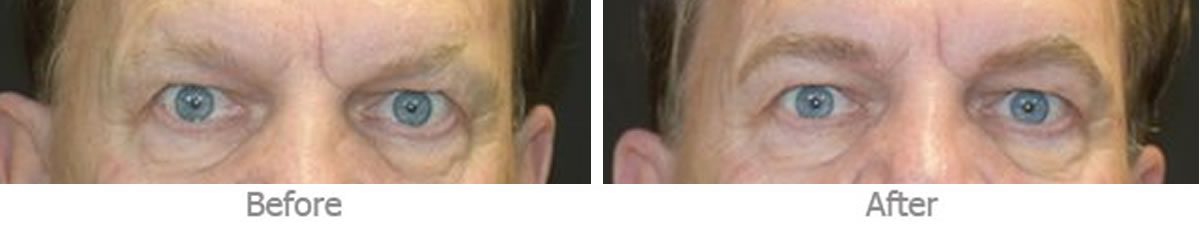 eyebrow tattoo patient results