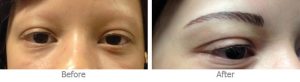 eyebrow tattoo restoration