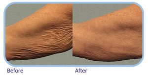 Skin tightening before and after