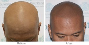 Scalp Micropigmentation before and after