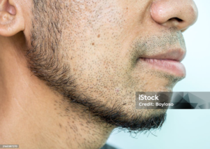 Side profile of a man with sparse beard hair growth.