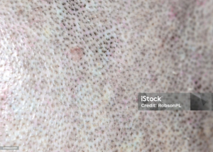 Close-up of skin with micropigmentation dots.
