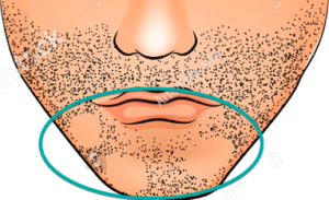 Illustration showing patchy beard growth on chin area.