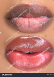Dark lip neutralization before and after treatment.