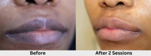 Lip Lightening before and after 2 sessions