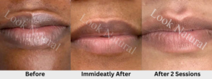 Lip Lightening before and after