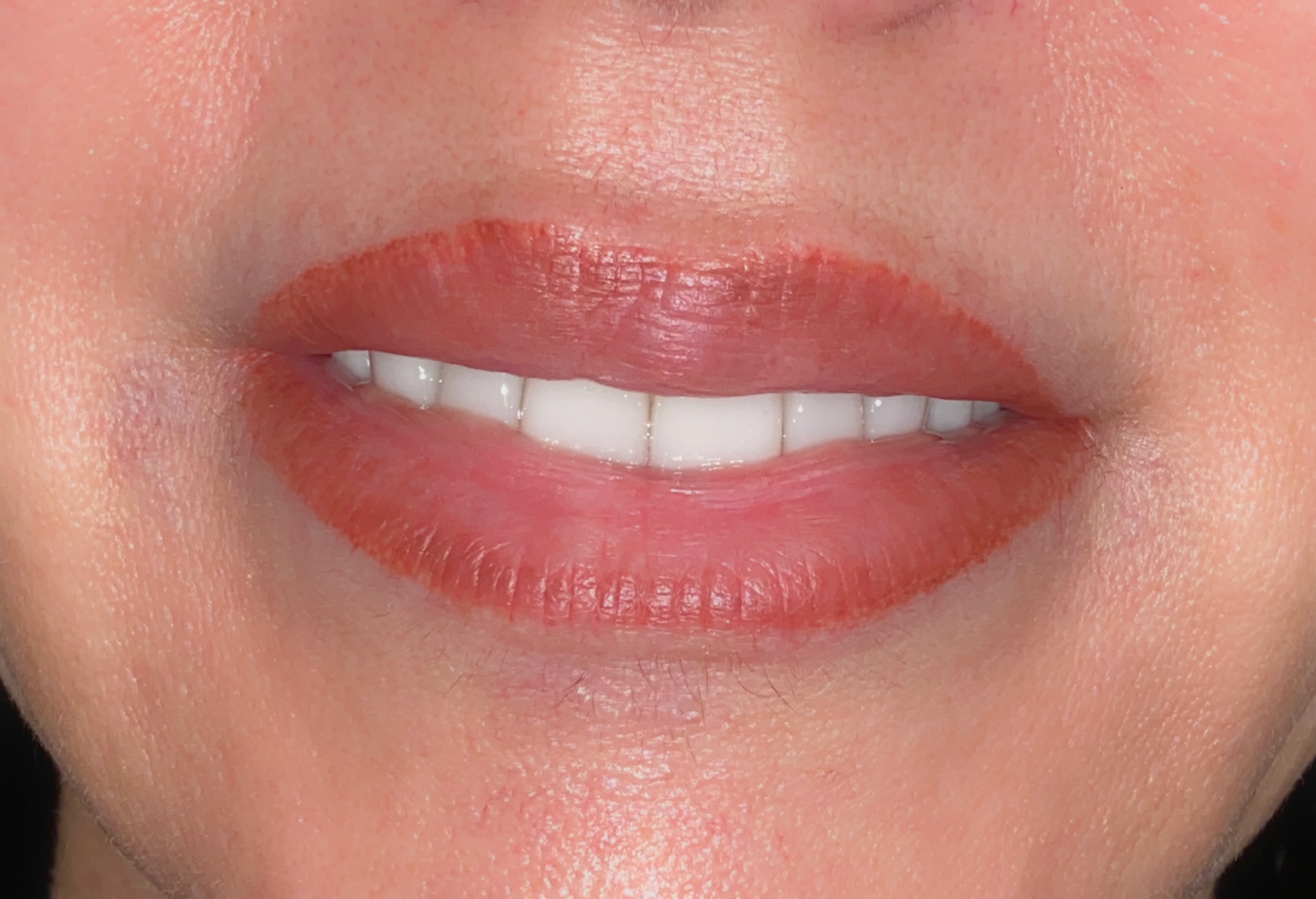 Lip Lightening results