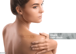 Woman with visible shoulder scar before camouflage treatment.