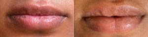 Lip Neutralization Atlanta
