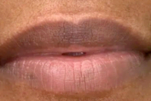 Close-up of unevenly pigmented lips before treatment.