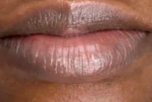 Close-up of dark pigmented lips before treatment.
