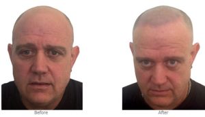 male scalp pigmentation