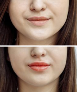 Lip Lightening before and after