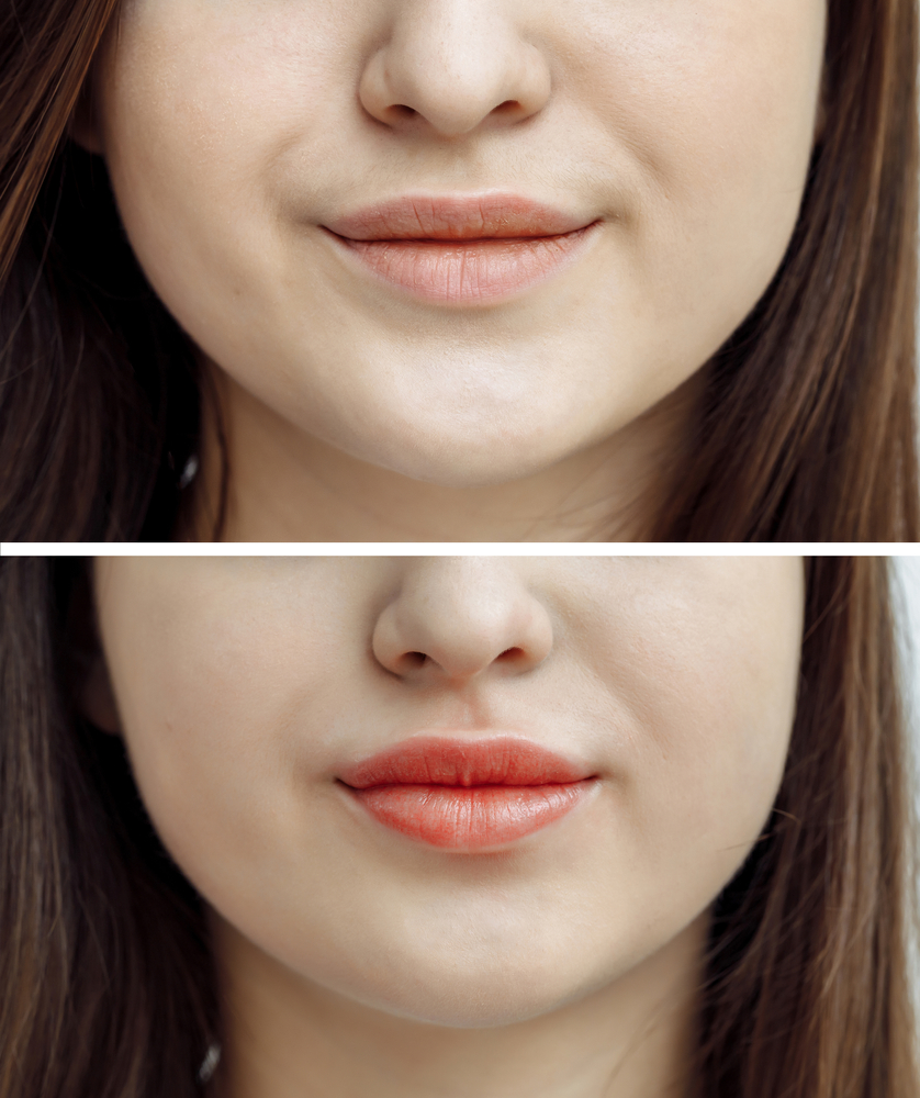 Lip Lightening before and after