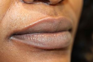 Lip Neutralization Atlanta GA