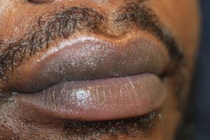 Lip Neutralization Atlanta GA