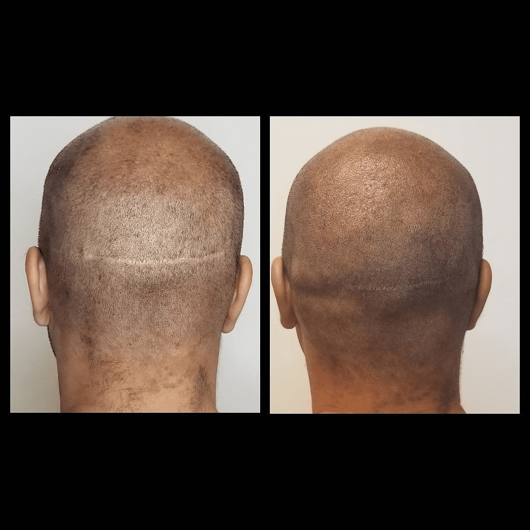 Scalp Scar Camouflage Atlanta