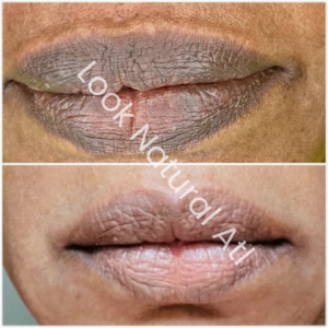 Lip Neutralization