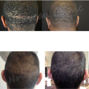 Before and after images of scalp micropigmentation treatment for scar camouflage on the back of the head.