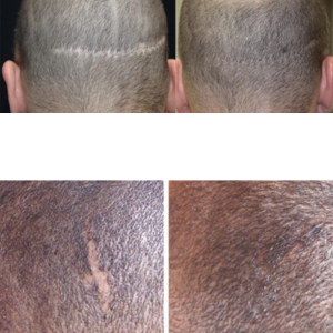 Before and after scalp micropigmentation treatment showing scar coverage on the scalp.