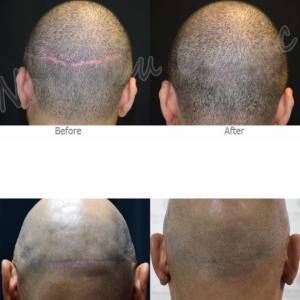 Before and after results of scalp micropigmentation showing scar concealment on the back of the scalp.