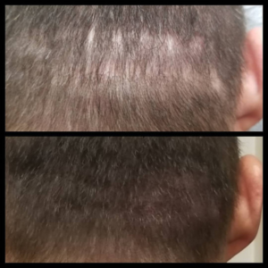 Before and after results of scalp micropigmentation showing scar coverage on the back of the head.