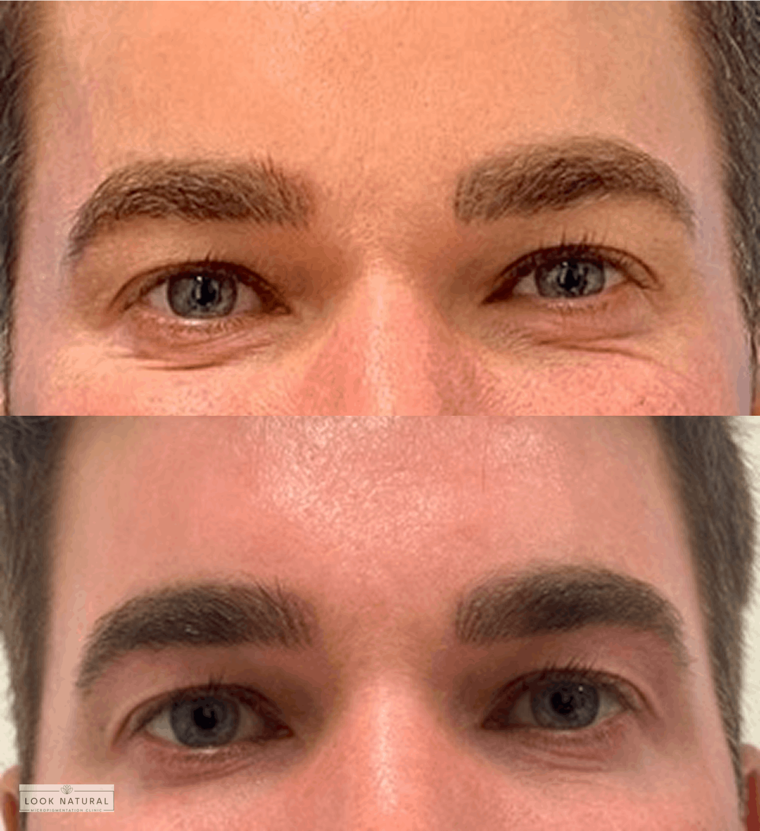 Before and after men’s eyebrow restoration treatment showing fuller, natural brows.
