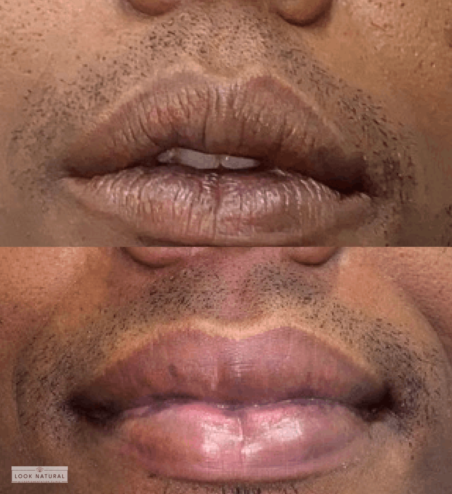 Dark male lips before and after professional lip neutralization treatment