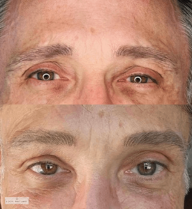 Before and after men’s eyebrow restoration showing improved thickness and shape.