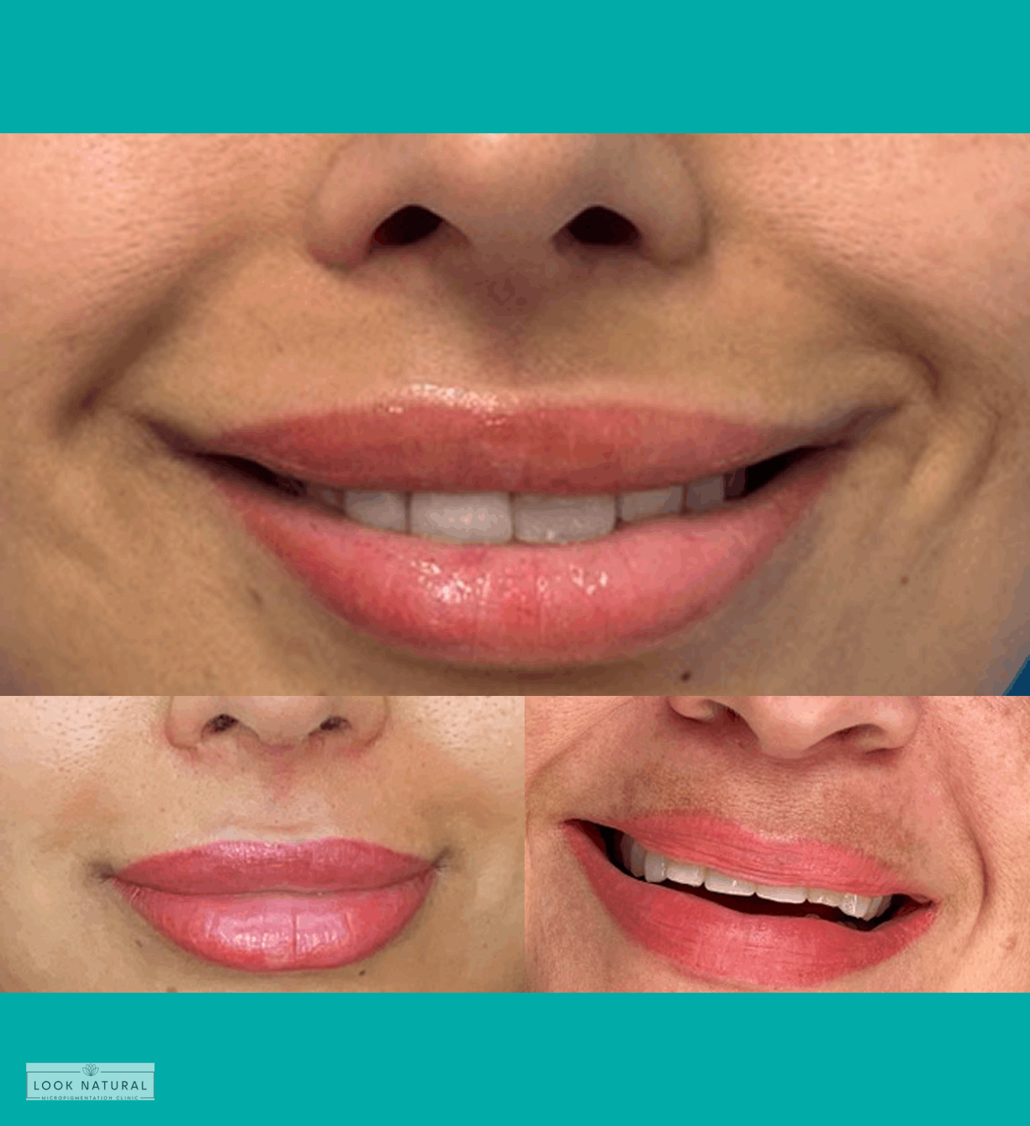 Semi-permanent lip blush treatment for soft, natural-looking tinted lips.