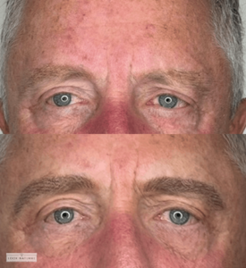 Before and after men’s eyebrow restoration treatment with fuller, natural brows.