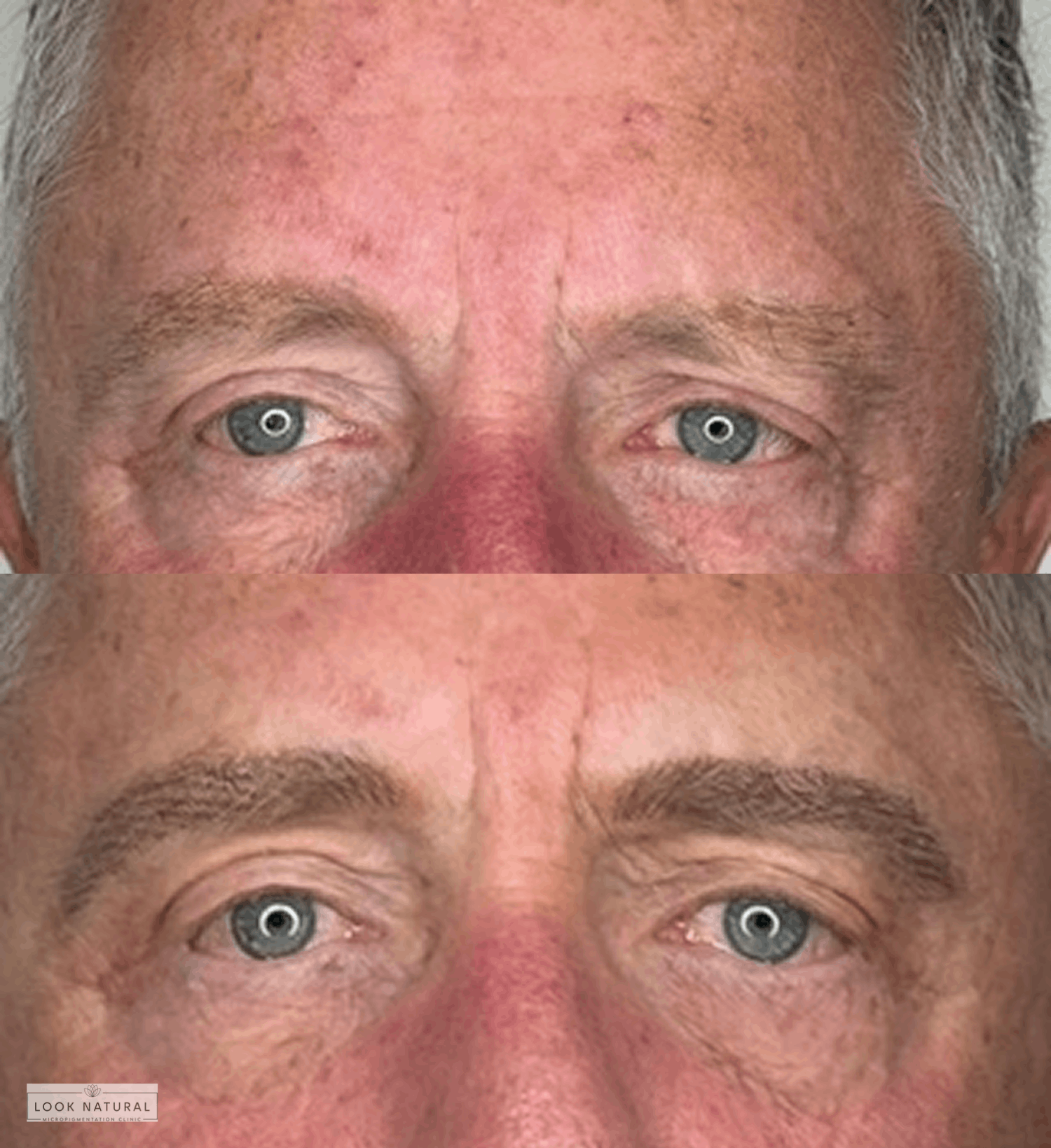 Before and after men’s eyebrow restoration treatment with fuller, natural brows.