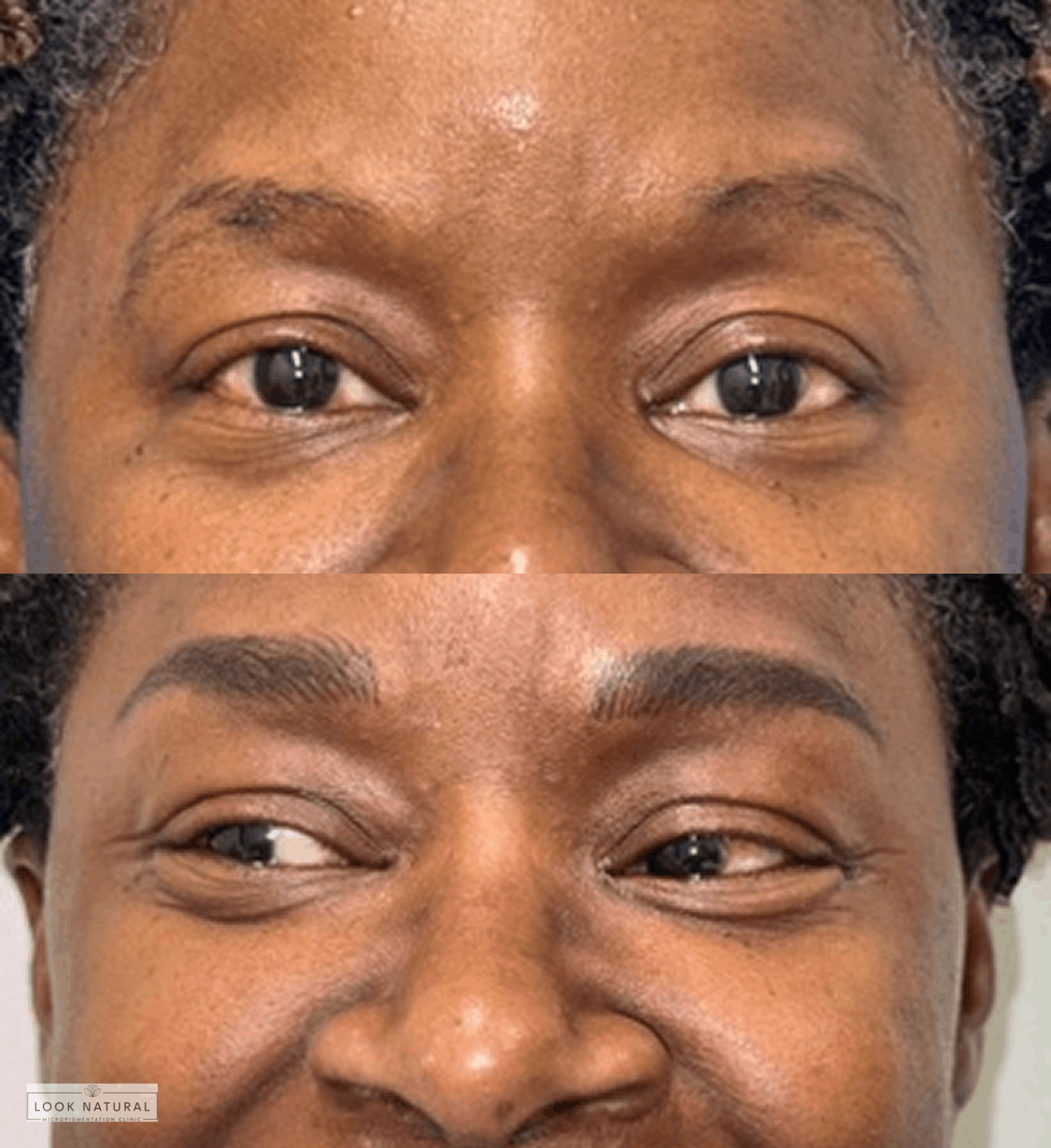 Before and after results of women’s eyebrow restoration with fuller brows.