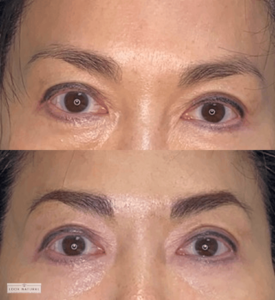 Natural eyebrow enhancement before and after restoration.