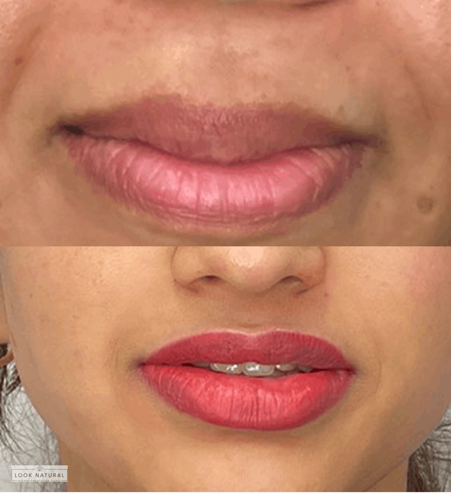 Soft pink lips with enhanced natural tone after lip neutralization treatment