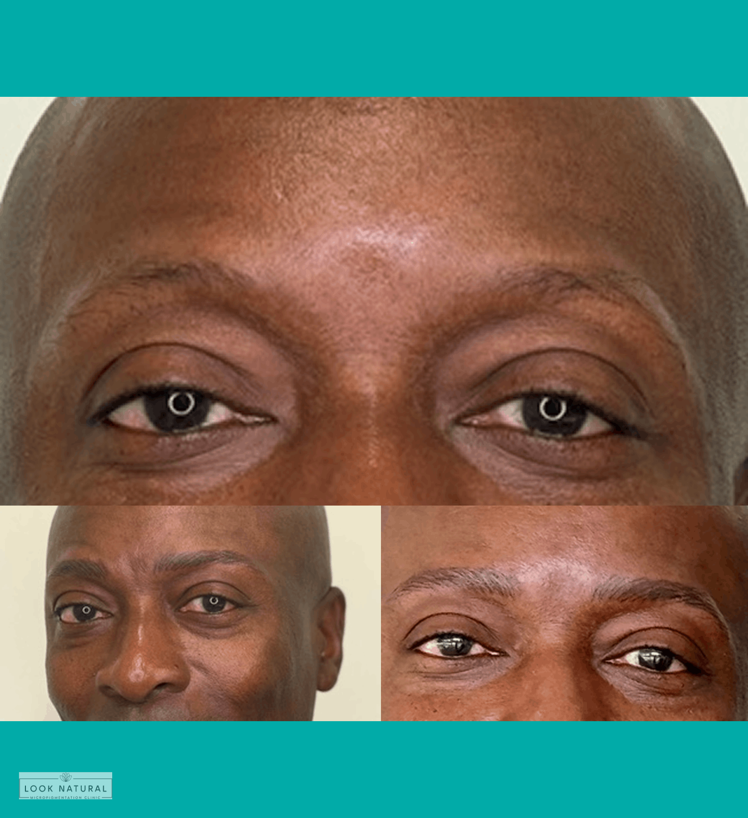 Before and after eyebrow restoration for men showing fuller and defined brows.