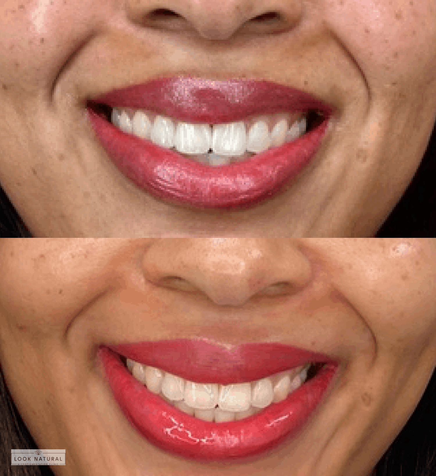 Bright smile showing even-toned lips after lip neutralization treatment