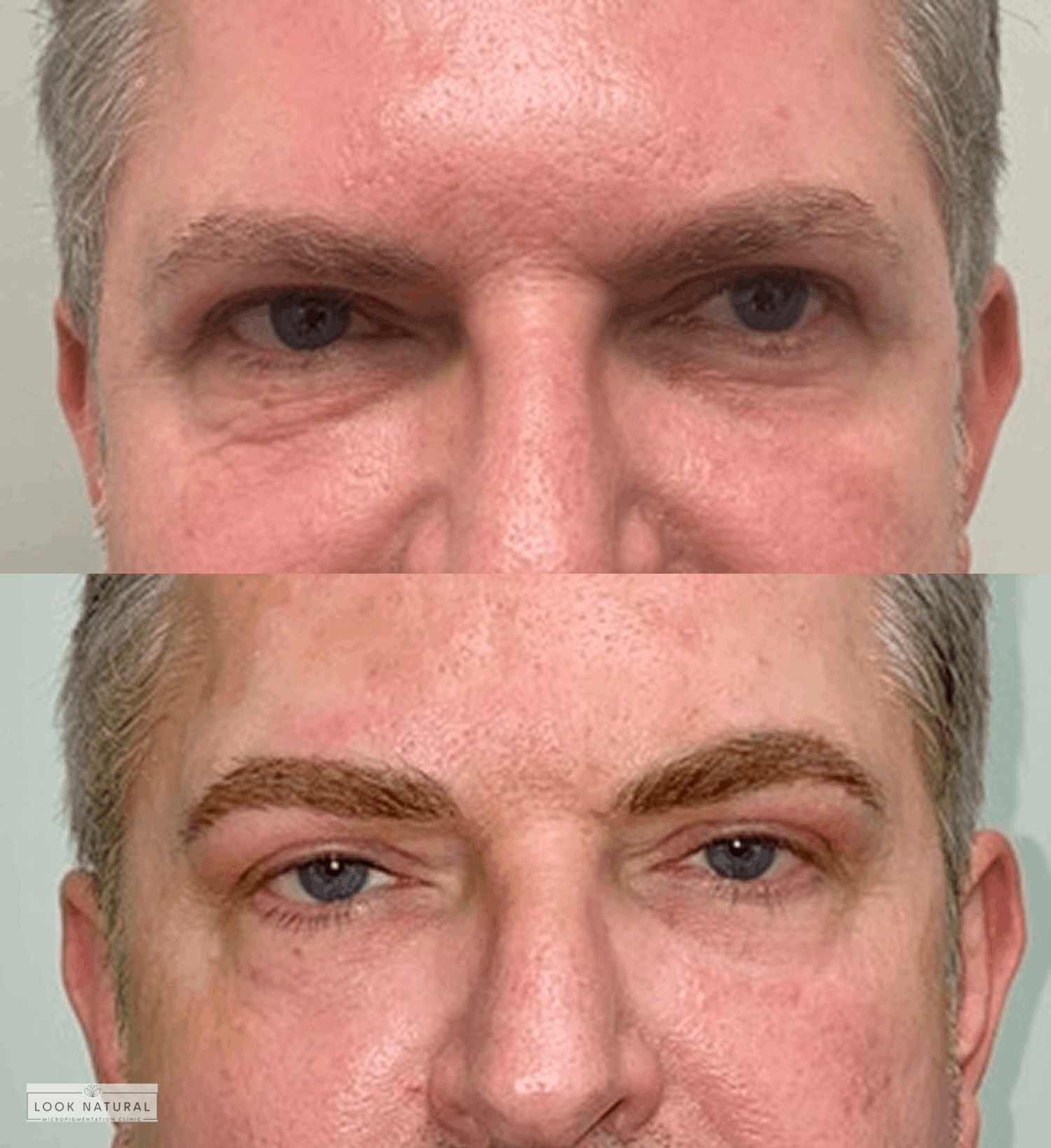 Before and after men’s eyebrow restoration showing transformation to thicker, natural-looking brows.