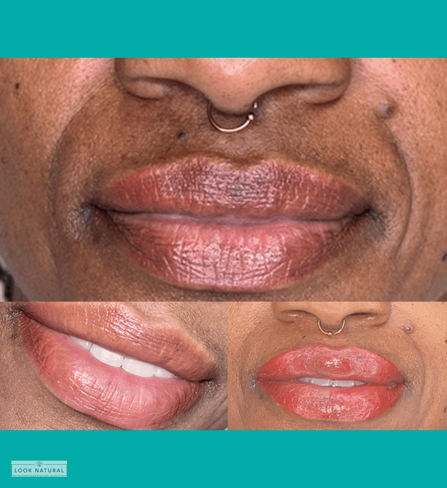 Before and after lip neutralization treatment for dark lips