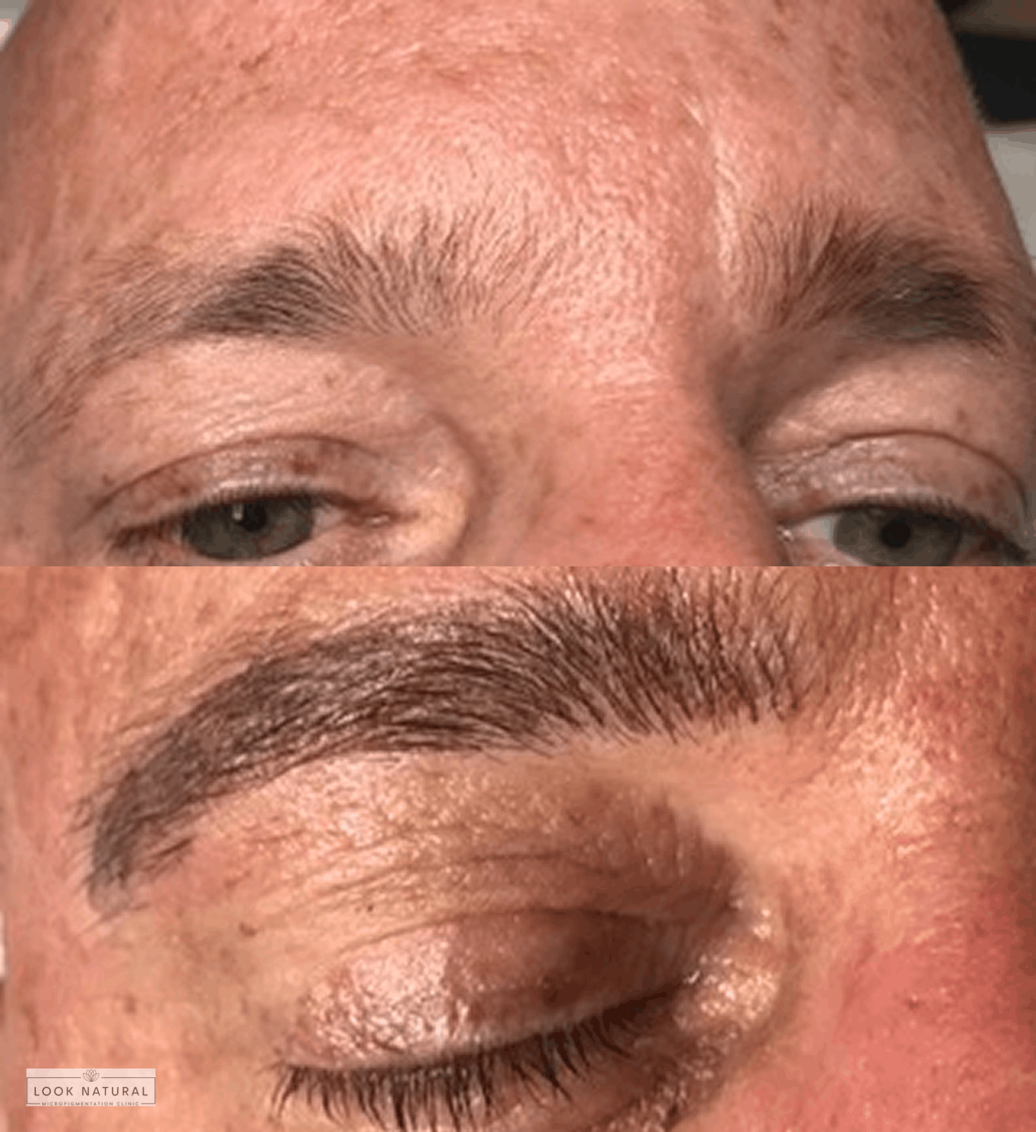 Before and after men’s eyebrow restoration showing transformation from sparse to full brows.