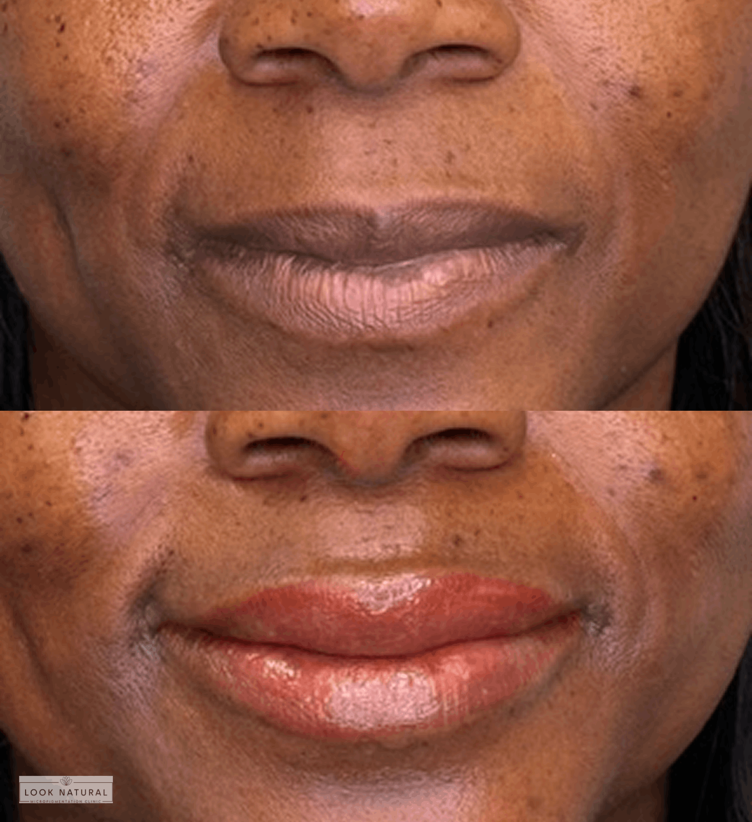 Before and after lip neutralization for dark lips