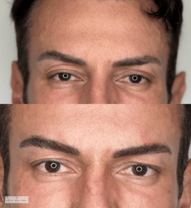Before and after men’s eyebrow restoration treatment showing fuller, well-shaped brows.