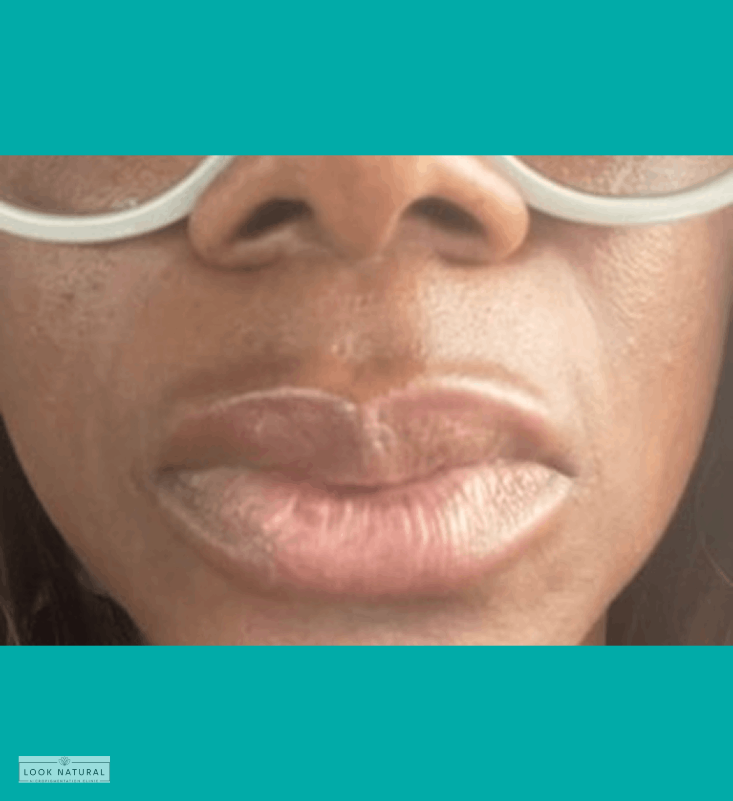 Lip lightening treatment for dark pigmented lips