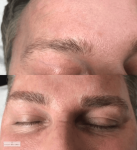 Before and after men’s eyebrow restoration showing improved density and shape.