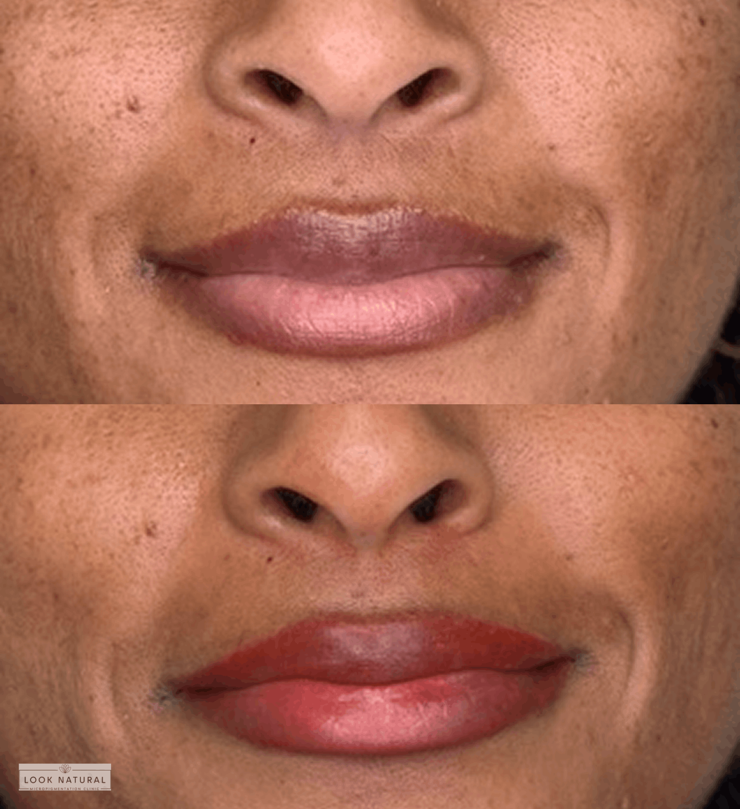 Lip neutralization and lightening treatment before and after results